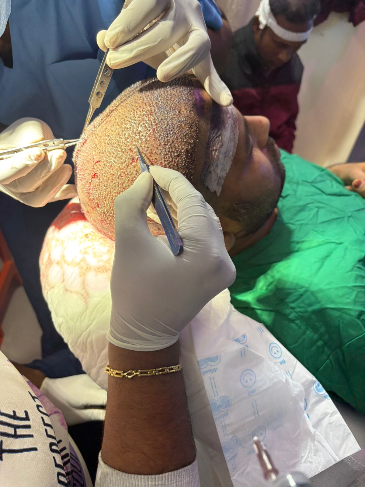 Hair Transplant Before/After