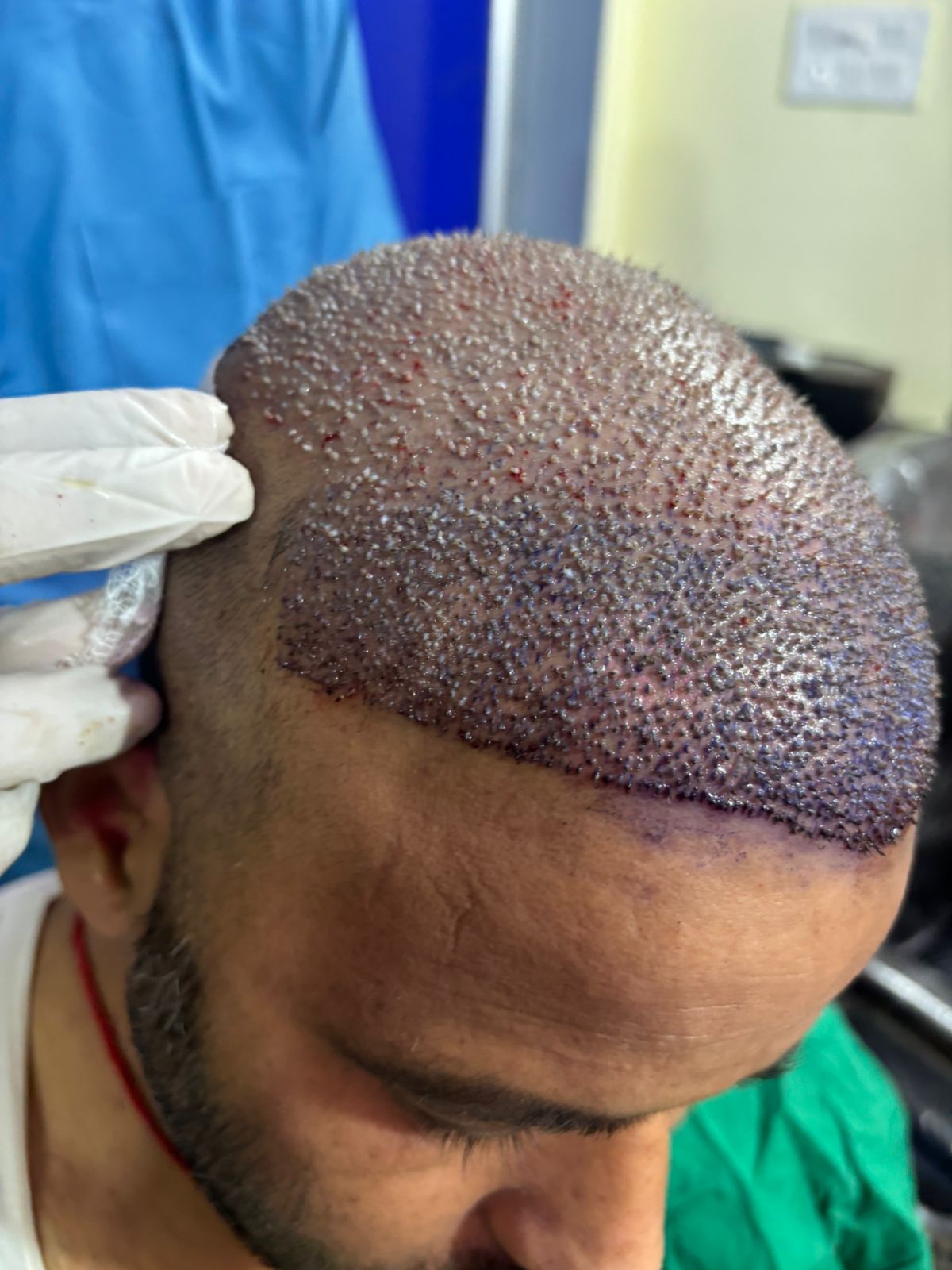 Laser Hair Removal Progress