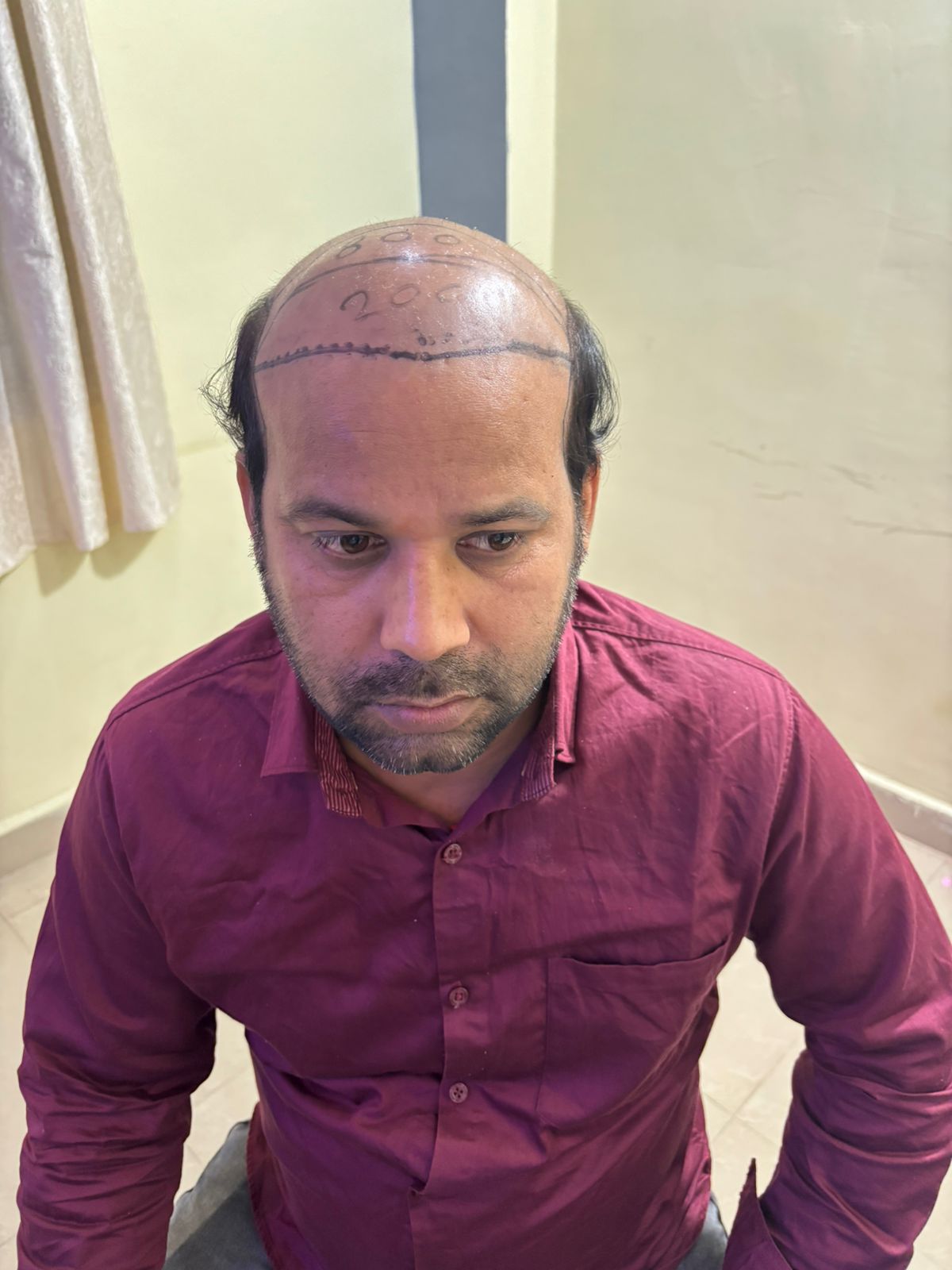 Skin Lightening Results